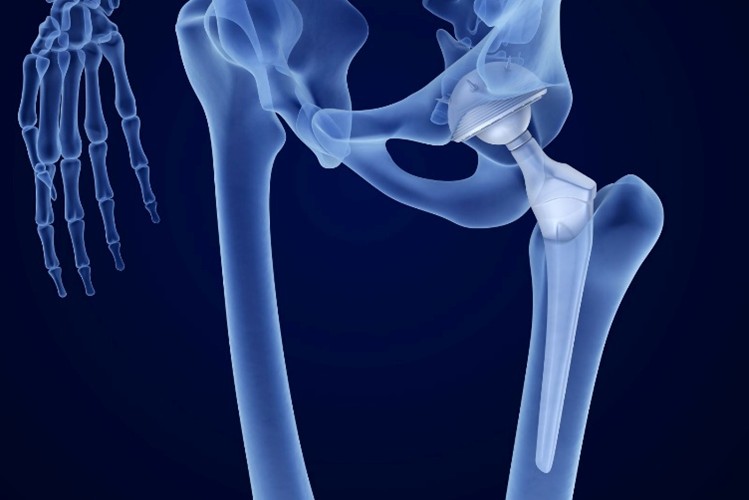 Oracle Precision Ltd sets the standard in orthopaedic manufacturing
